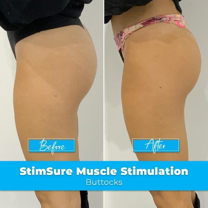 Images Elite Body Contouring Rosebery