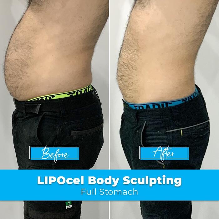 Images Elite Body Contouring Rosebery