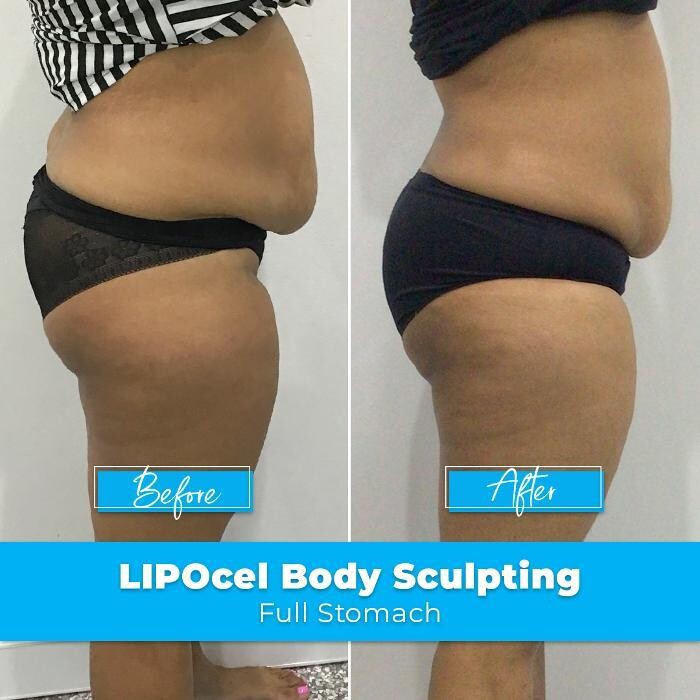 Images Elite Body Contouring Rosebery