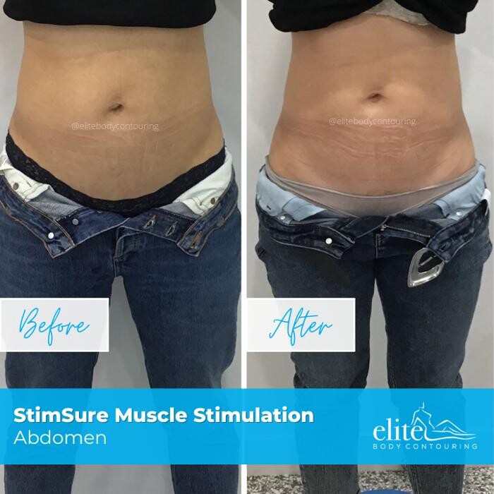 Images Elite Body Contouring Rosebery