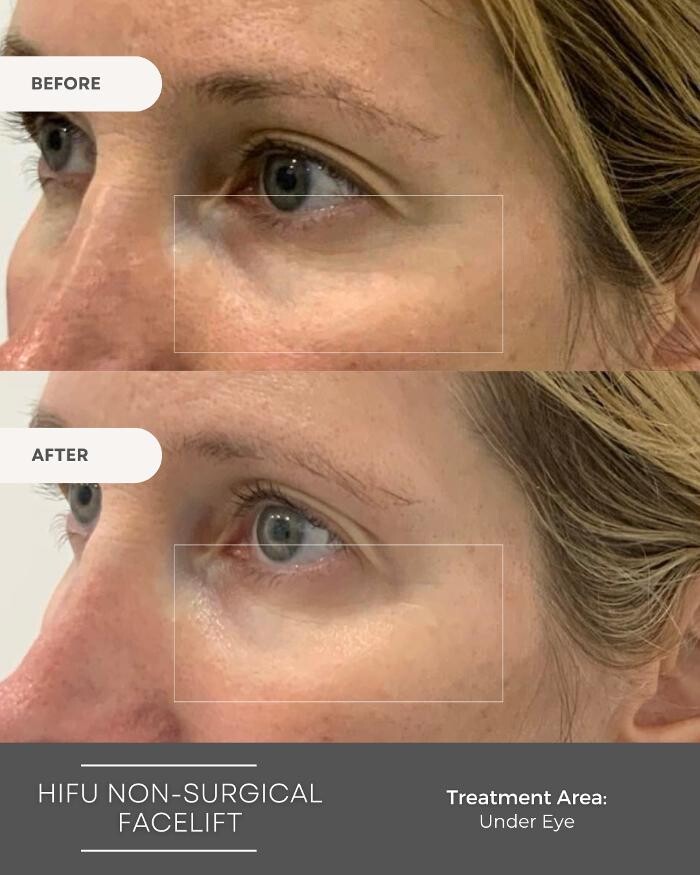 Images Elite Body Contouring Rosebery