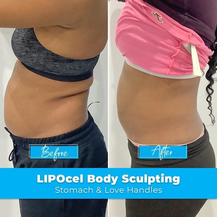 Images Elite Body Contouring Rosebery