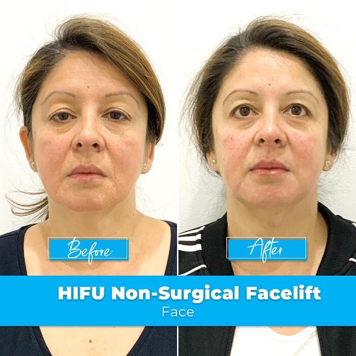 Images Elite Body Contouring Brookvale