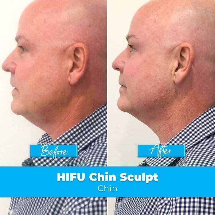 Images Elite Body Contouring Brookvale