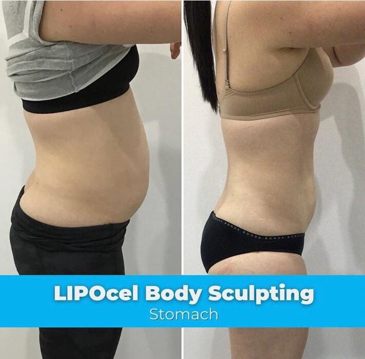 Images Elite Body Contouring Brookvale