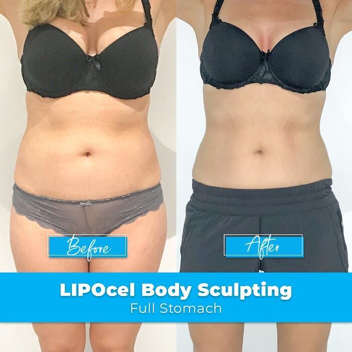 Images Elite Body Contouring Brookvale