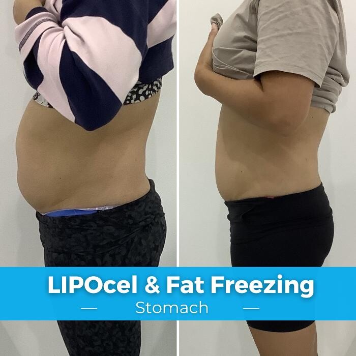 Images Elite Body Contouring Brookvale