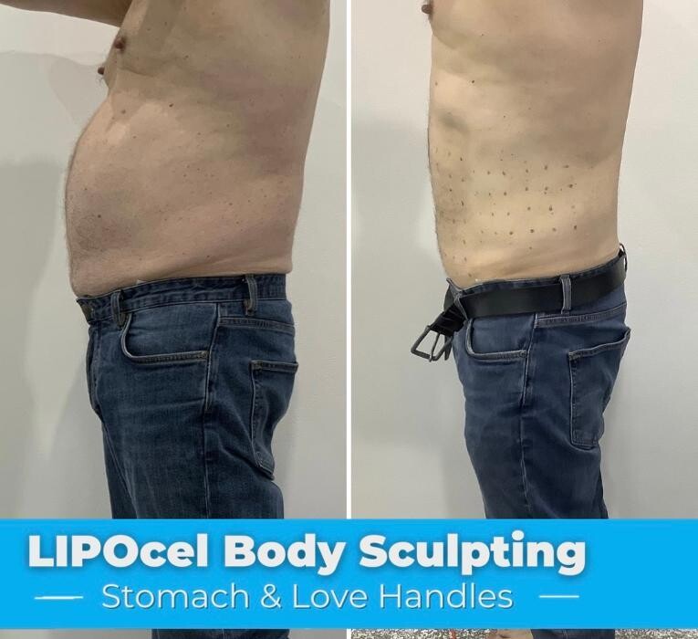 Images Elite Body Contouring Miranda