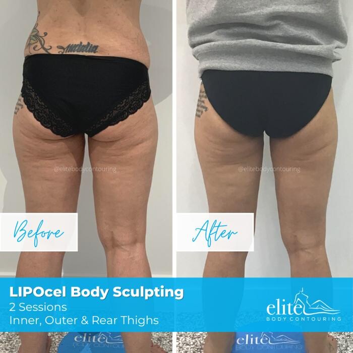 Images Elite Body Contouring Miranda