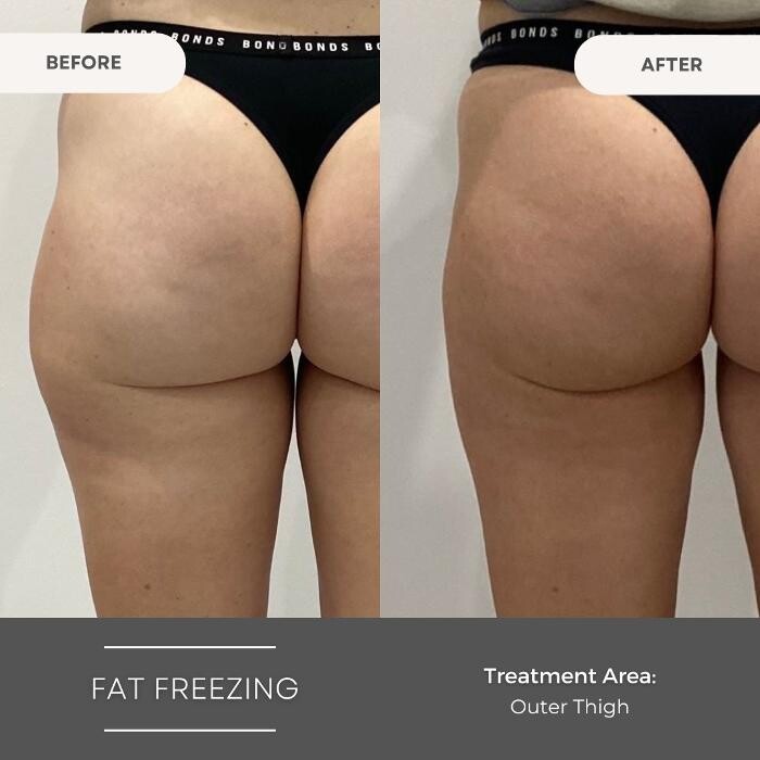 Images Elite Body Contouring Bondi Junction