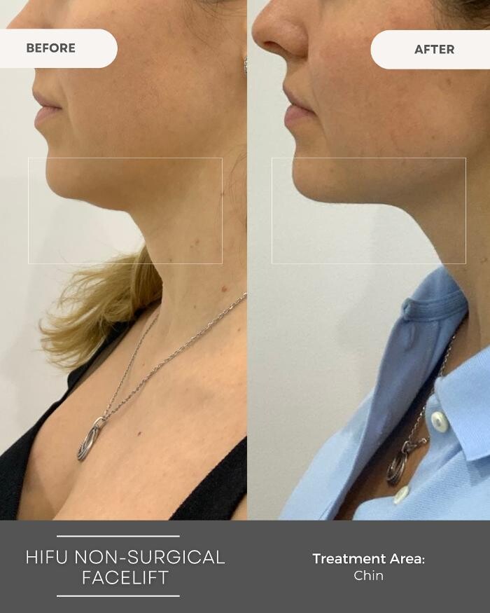 Images Elite Body Contouring Bondi Junction