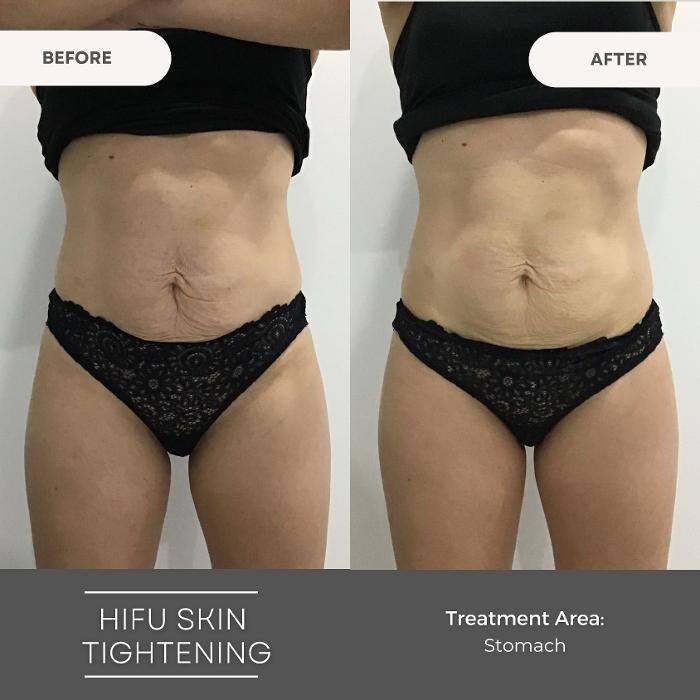 Images Elite Body Contouring Bondi Junction