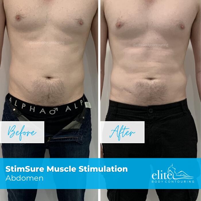 Images Elite Body Contouring Cronulla