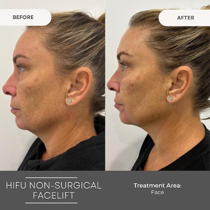 Images Elite Body Contouring Cronulla