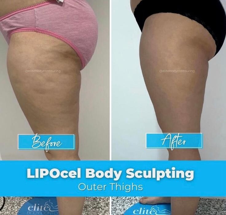 Images Elite Body Contouring Cronulla