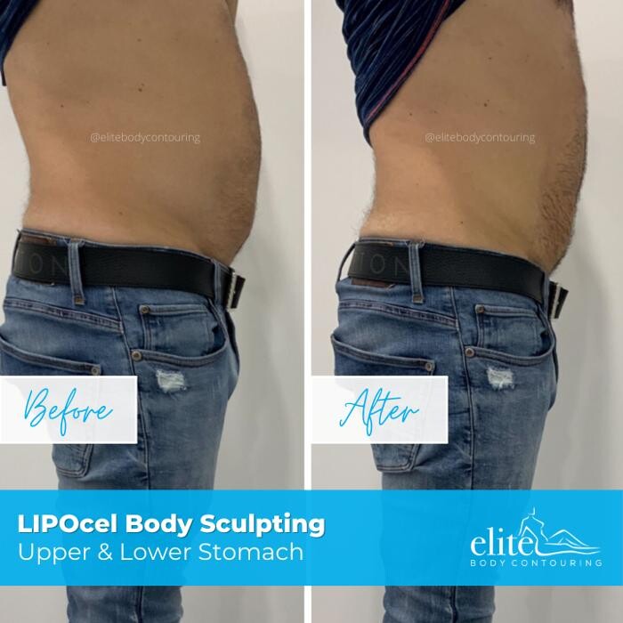Images Elite Body Contouring Cronulla