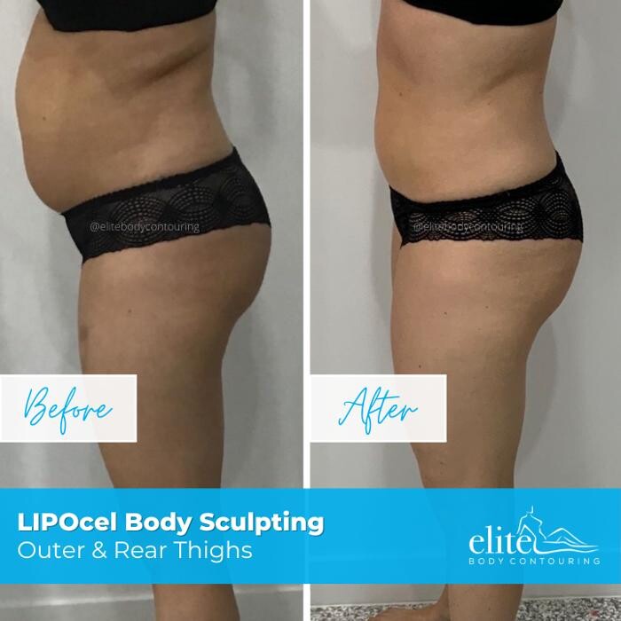 Images Elite Body Contouring Cronulla