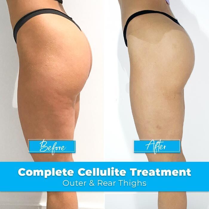 Images Elite Body Contouring Cronulla