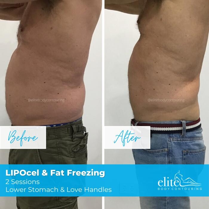 Images Elite Body Contouring Cronulla
