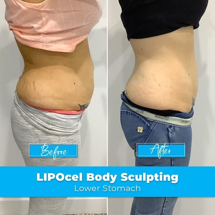 Images Elite Body Contouring Cronulla
