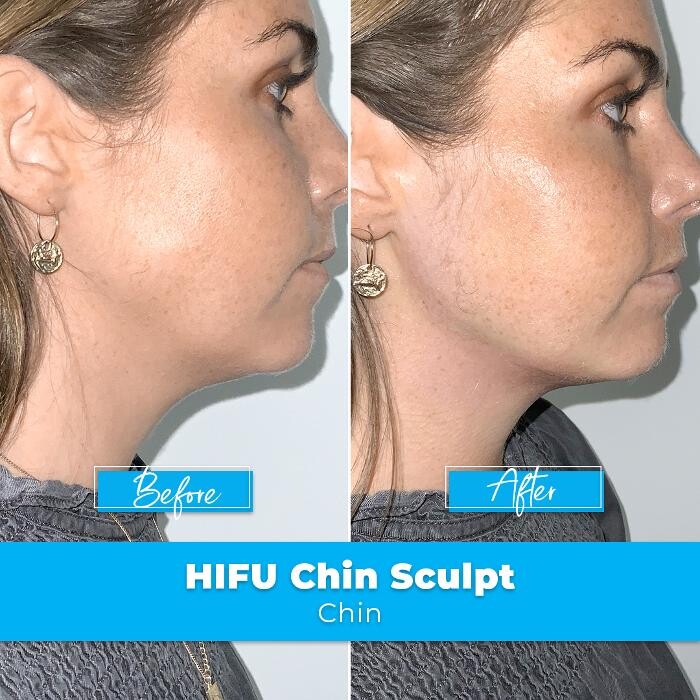 Images Elite Body Contouring Cronulla