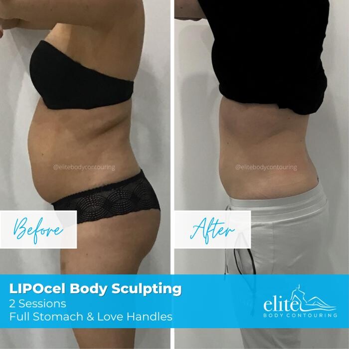 Images Elite Body Contouring Cronulla