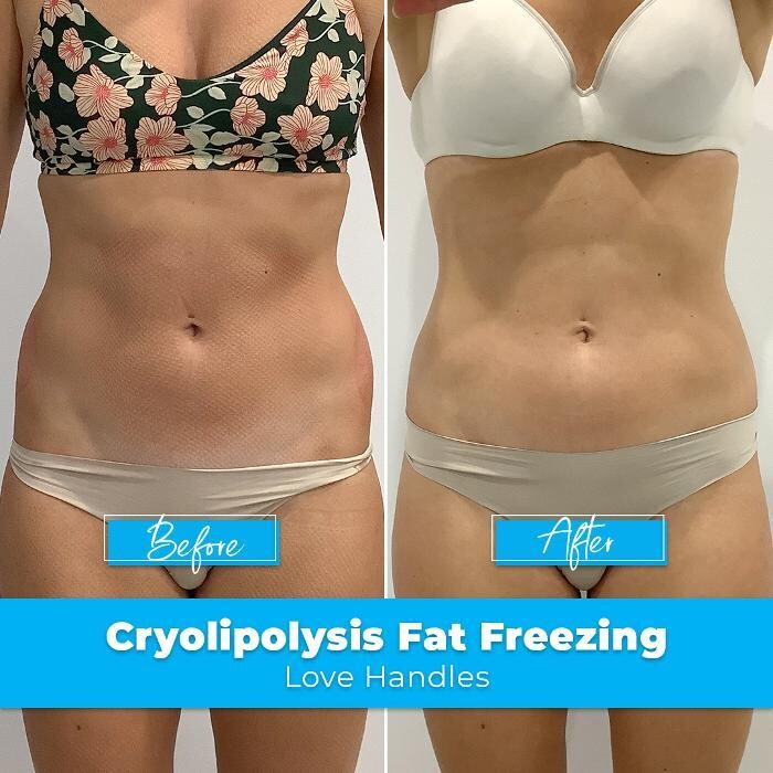 Images Elite Body Contouring Cronulla