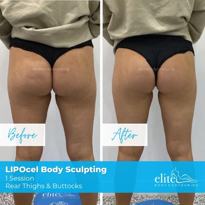 Images Elite Body Contouring Cronulla