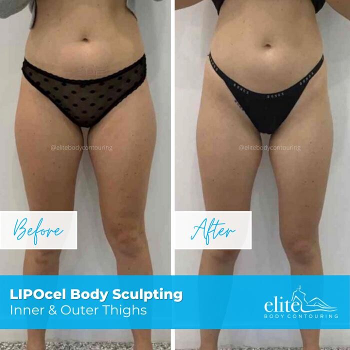 Images Elite Body Contouring Cronulla