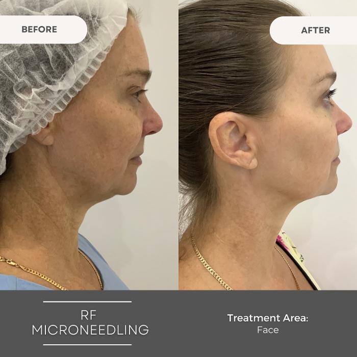 Images Elite Body Contouring Cronulla
