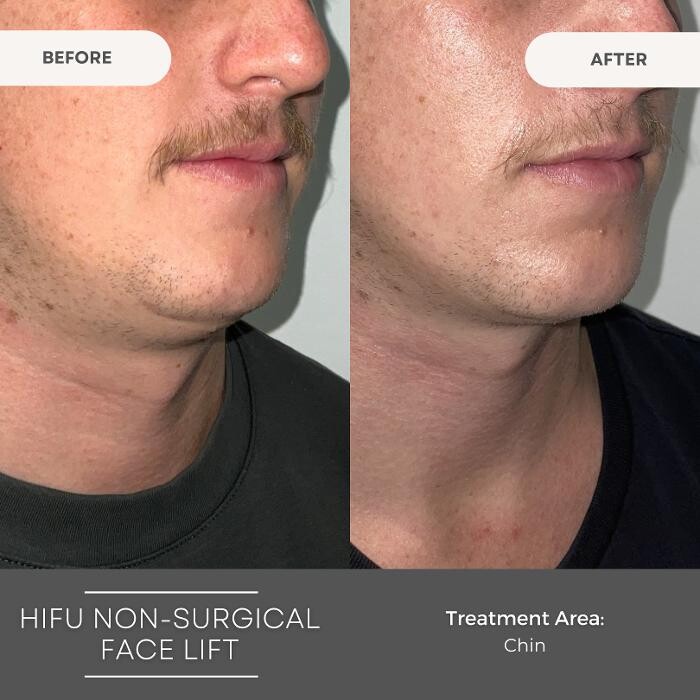 Images Elite Body Contouring Cronulla
