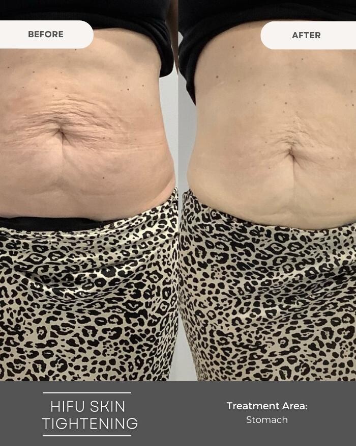 Images Elite Body Contouring Edmondson Park