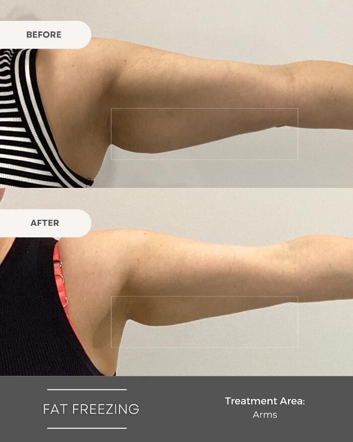 Images Elite Body Contouring Edmondson Park