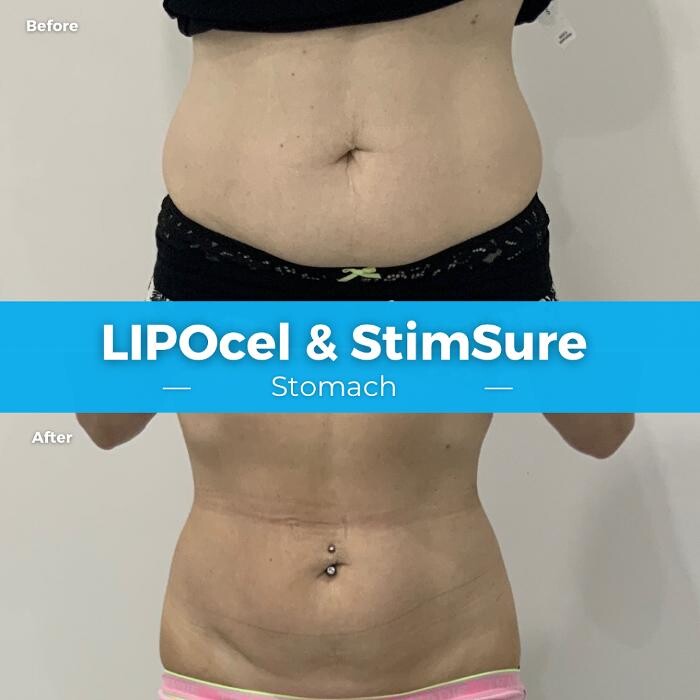 Images Elite Body Contouring Leichhardt