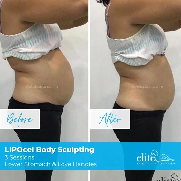 Images Elite Body Contouring Leichhardt