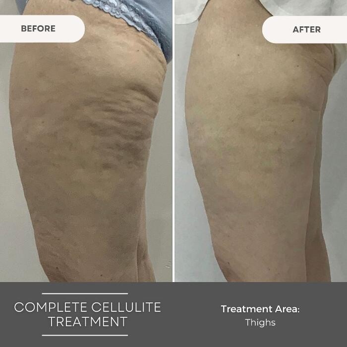 Images Elite Body Contouring Wollongong