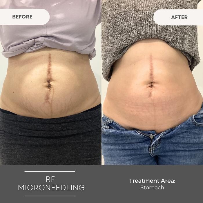 Images Elite Body Contouring Wollongong