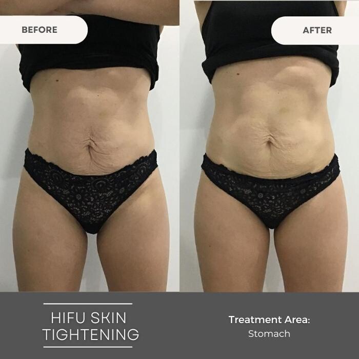 Images Elite Body Contouring Wollongong