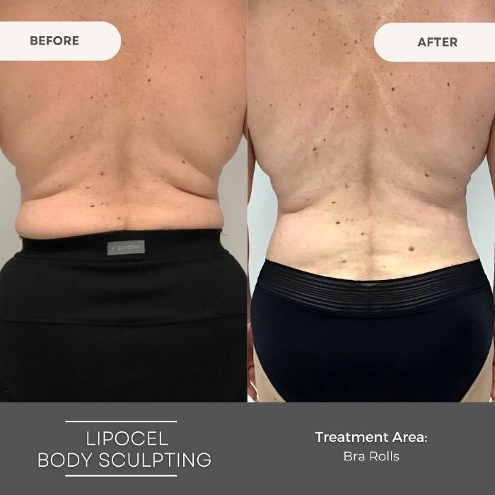 Images Elite Body Contouring Wollongong