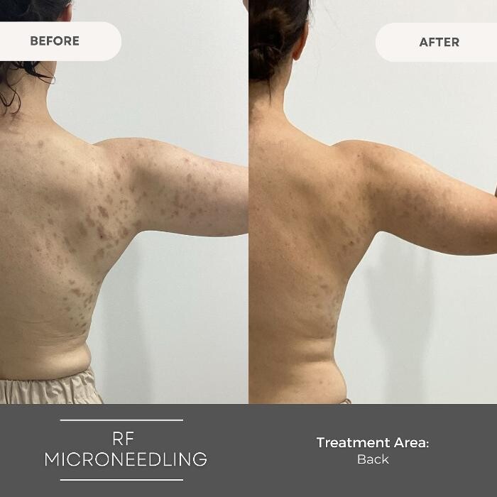 Images Elite Body Contouring Wollongong