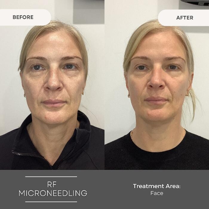 Images Elite Body Contouring Wollongong