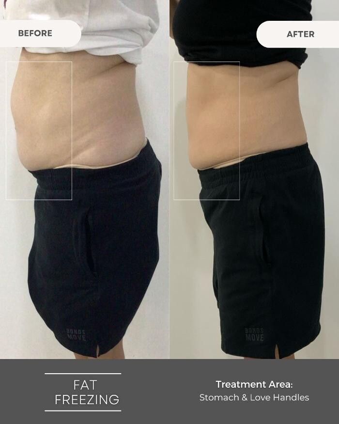 Images Elite Body Contouring Wollongong