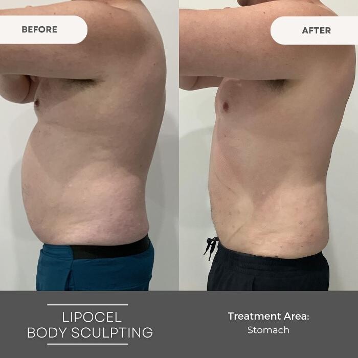 Images Elite Body Contouring Wollongong