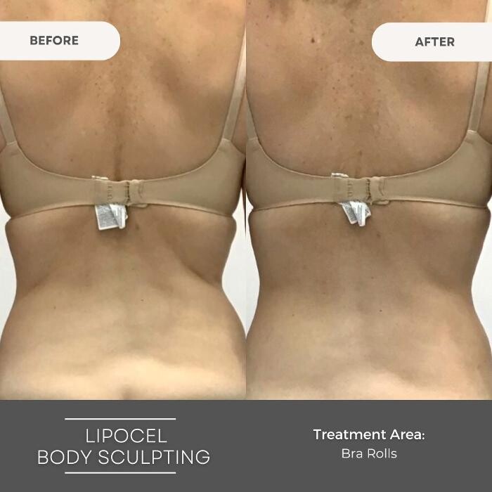 Images Elite Body Contouring Wollongong