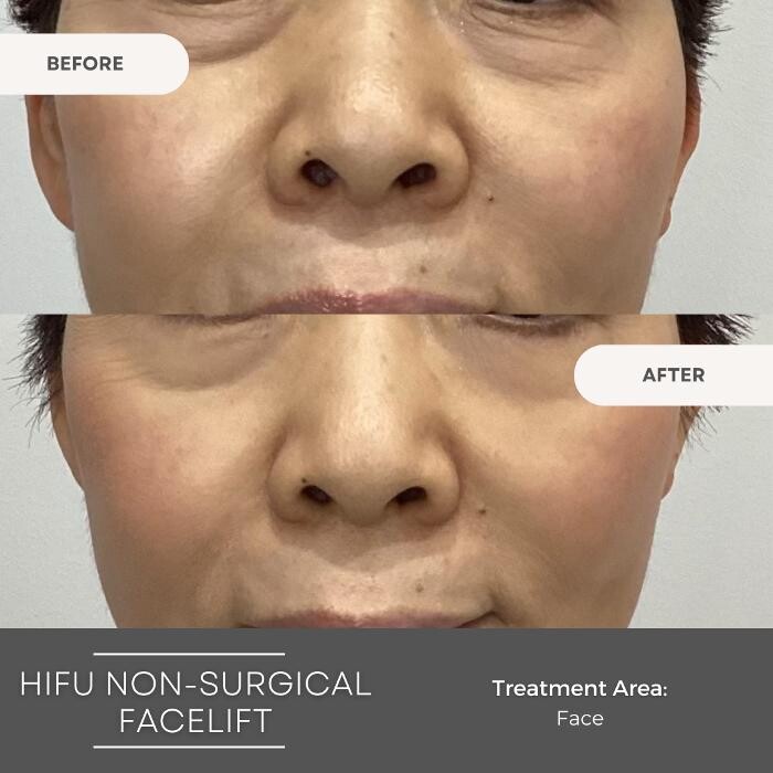 Images Elite Body Contouring Wollongong