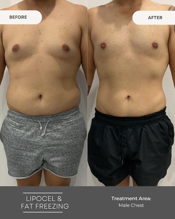 Images Elite Body Contouring Wollongong