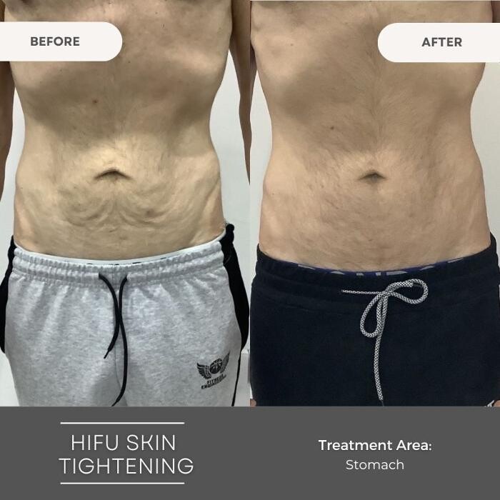 Images Elite Body Contouring Wollongong