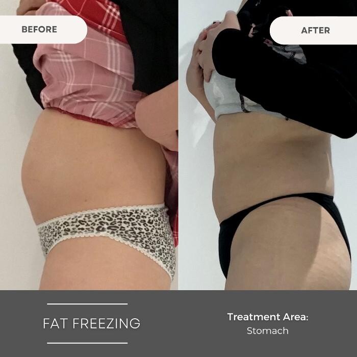 Images Elite Body Contouring Wollongong