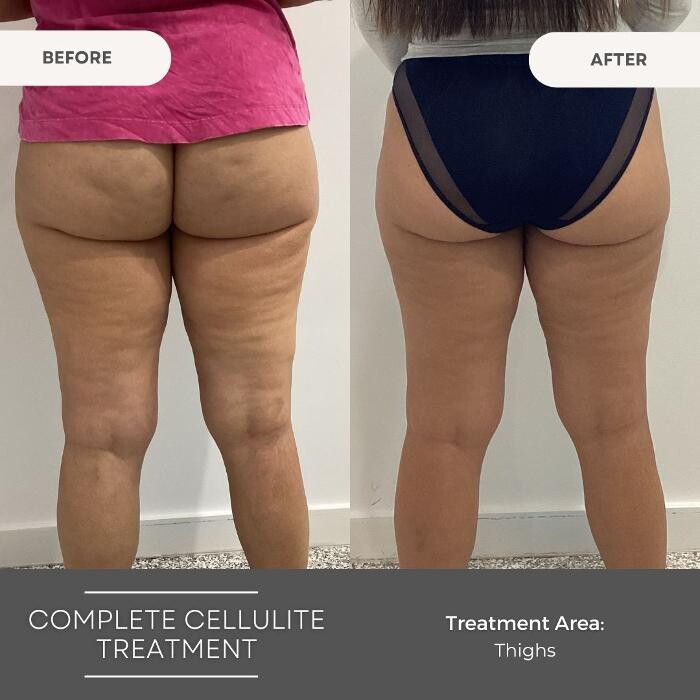 Images Elite Body Contouring Wollongong