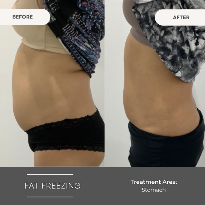 Images Elite Body Contouring Wollongong